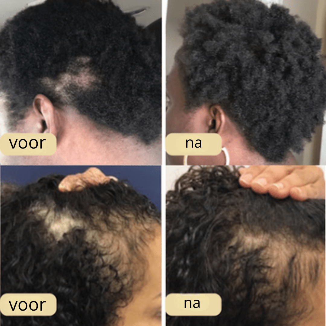 VitalRose™| 100% natürlich Haarwuchsöl - Finezo.de