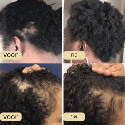 VitalRose™| 100% natürlich Haarwuchsöl - Finezo.de