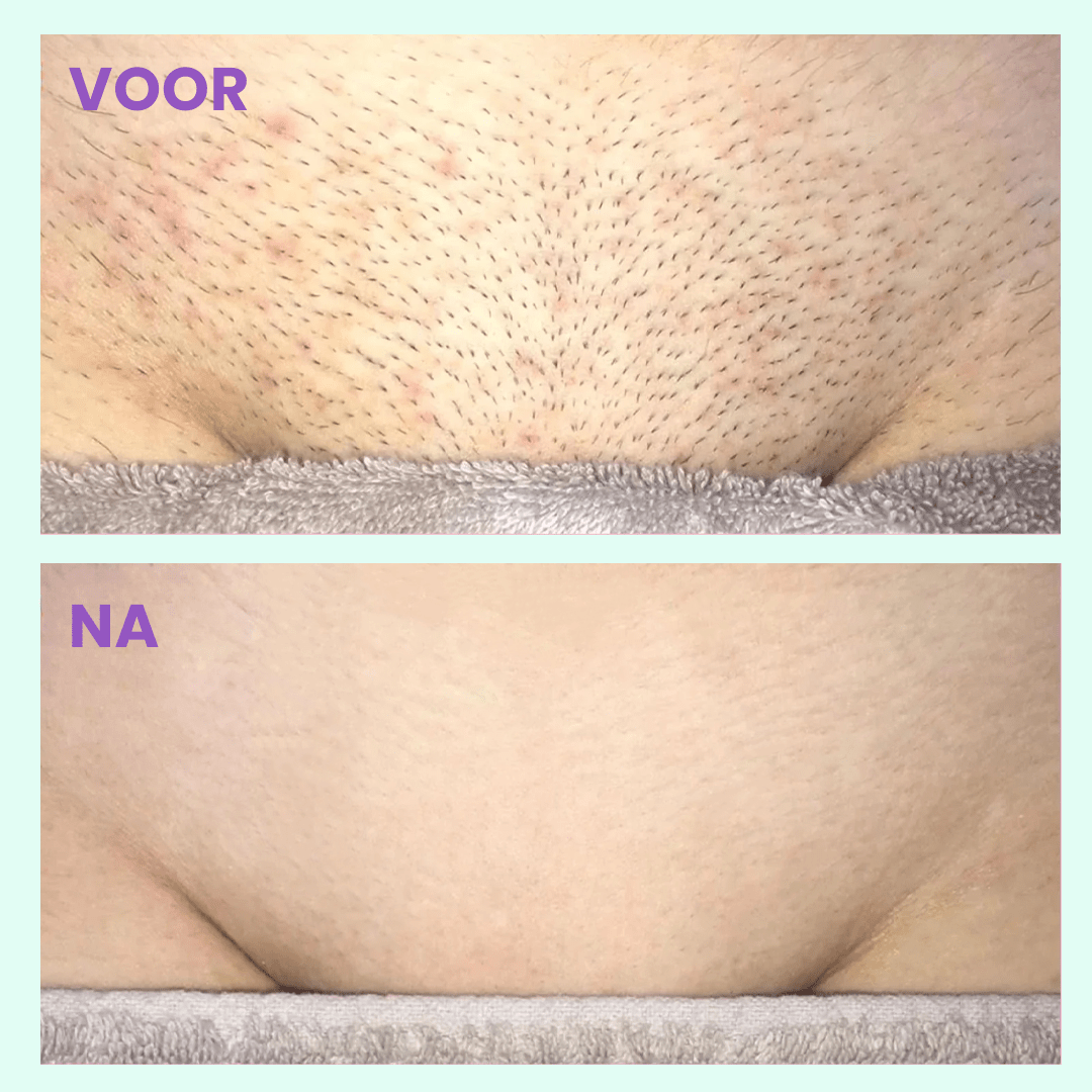 Flawless™ | Schmerzfreies Haarentfernungsgerät - Finezo.de