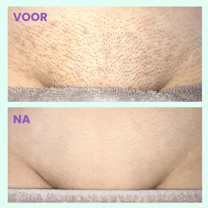 Flawless™ | Schmerzfreies Haarentfernungsgerät - Finezo.de