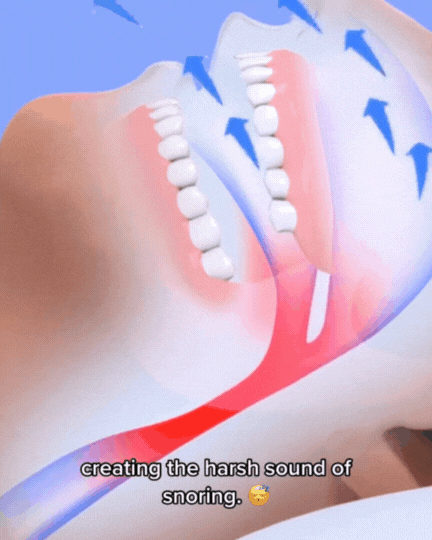 SchlafGut Schnarchstopper