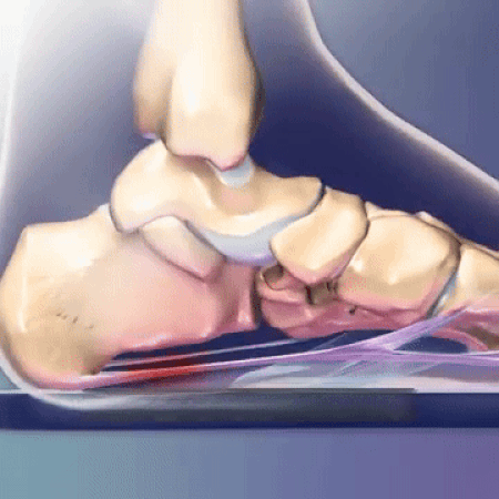 Relix™ | Bequeme Schlaforthese für Füße | 1+1 GRATIS