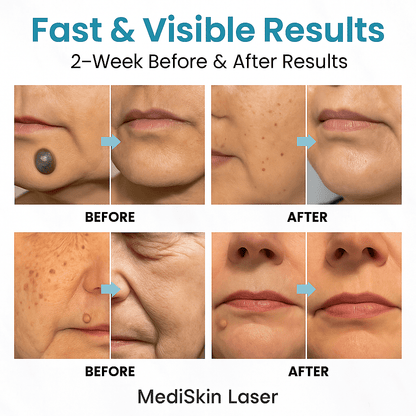 SkinPro™ | Hautfreundlicher Laserstift